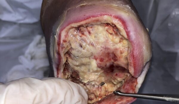 زخم پای دیابتی ناحیه پاشنه پر از بافت های عفونی قبل از لارو درمانی