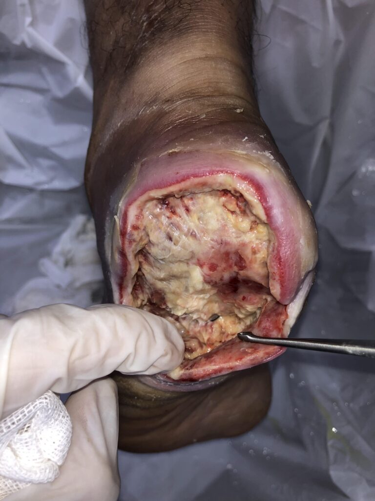زخم پای دیابتی ناحیه پاشنه پر از بافت های عفونی قبل از لارو درمانی