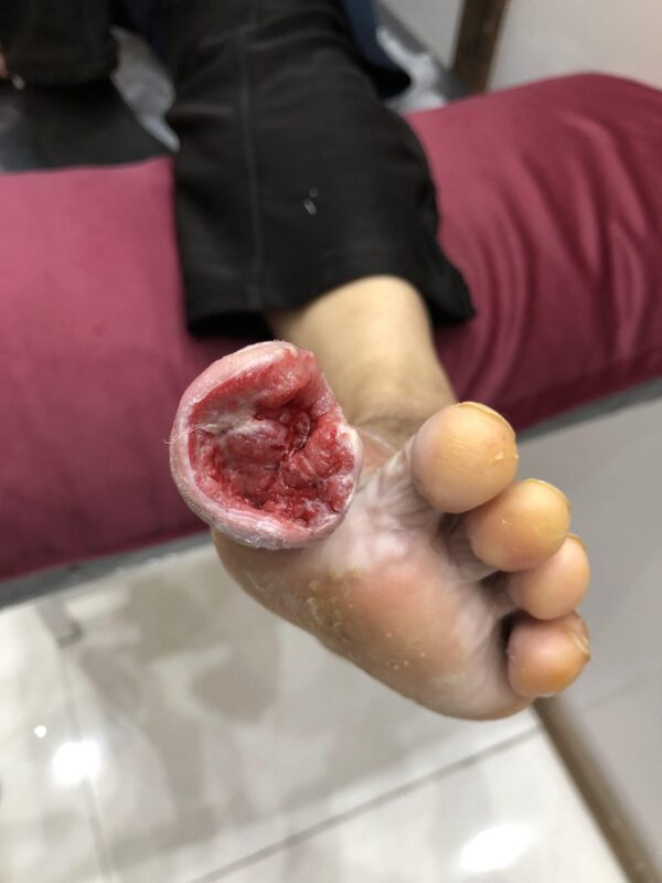 زخم پای دیابتی روی انگشت بعد از لارو درمانی